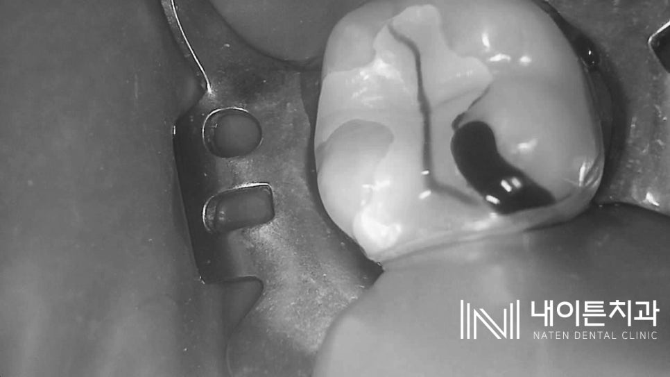 Treatment case image 7