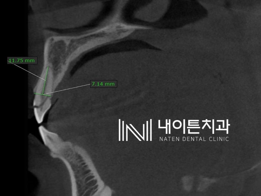 Treatment case image 3