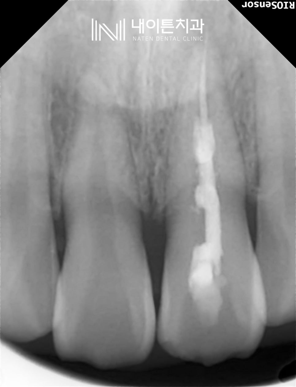 Treatment case image 2