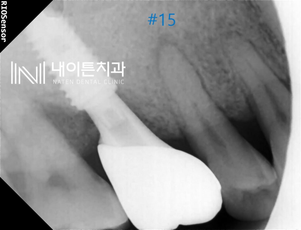 Treatment case image 2