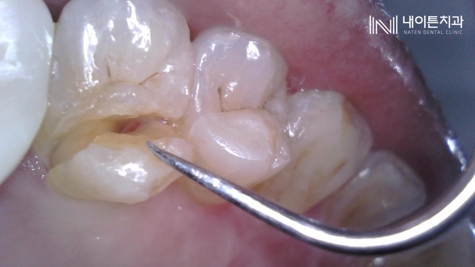Treatment case image 3
