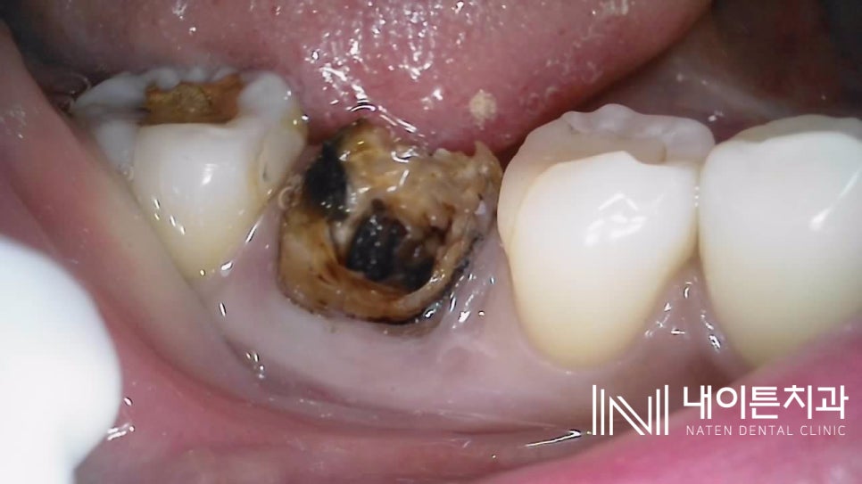 Treatment case image 1