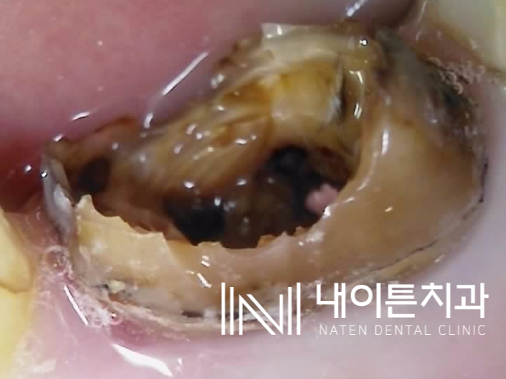 Treatment case image 2