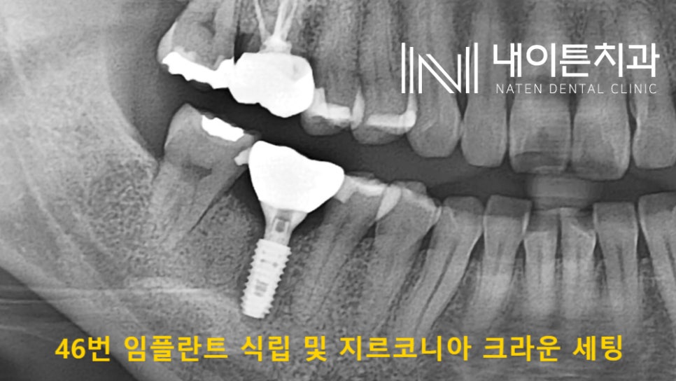 Treatment case image 6