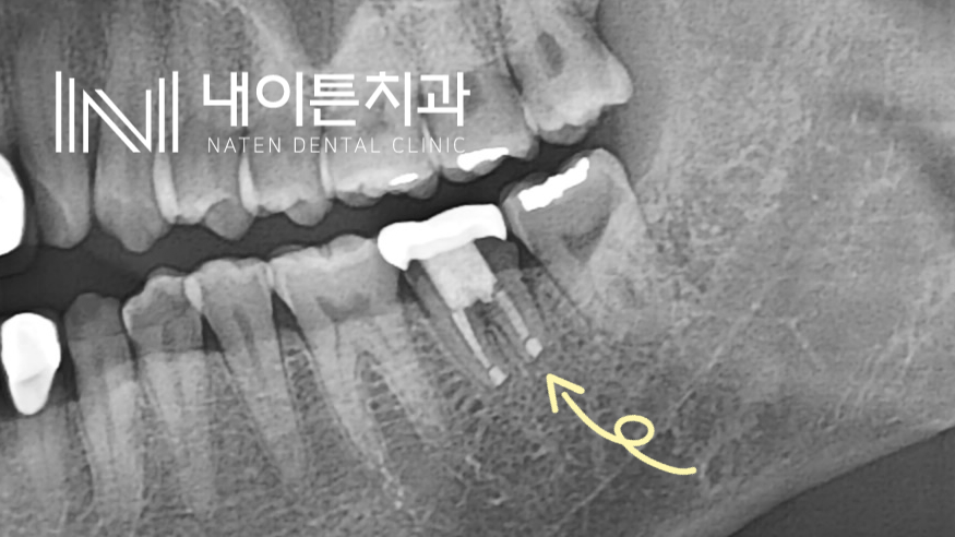 Treatment case image 2