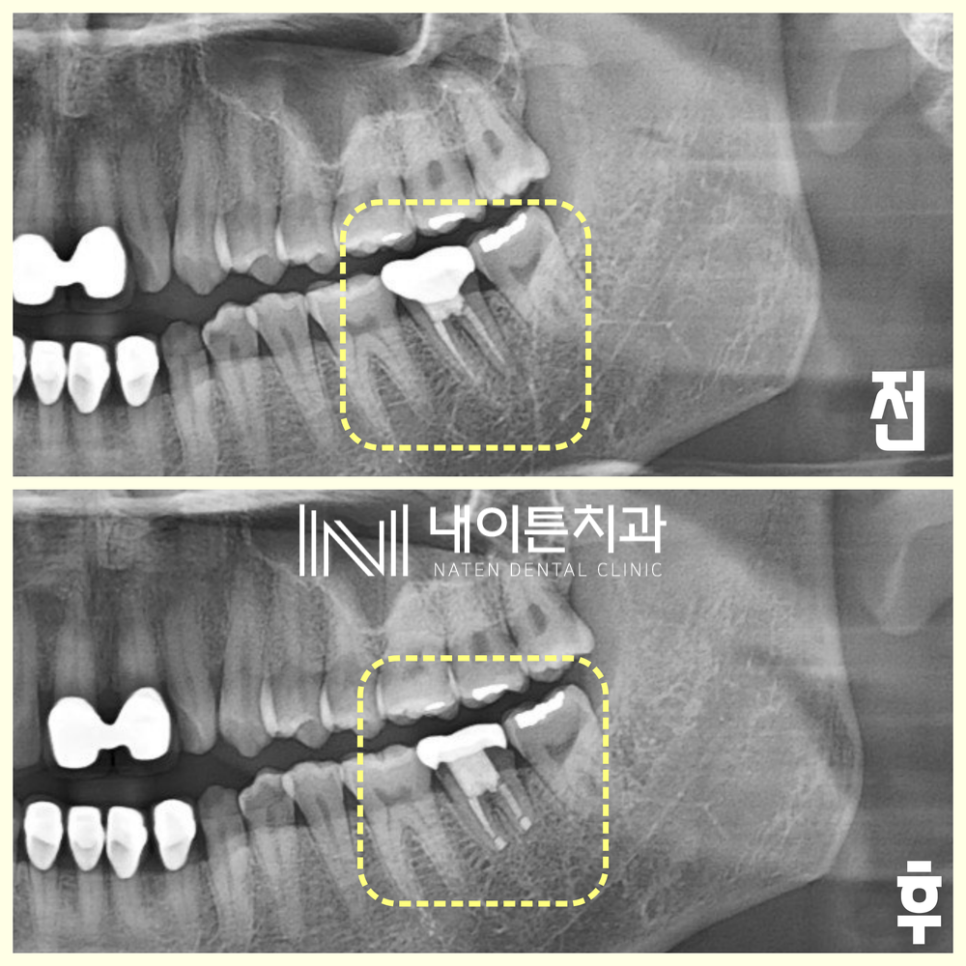 Treatment case image 4