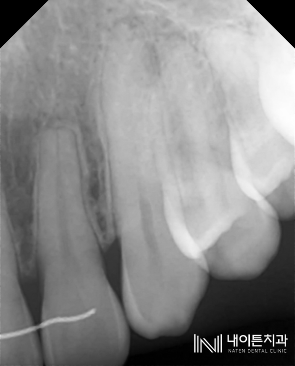 Treatment case image 2