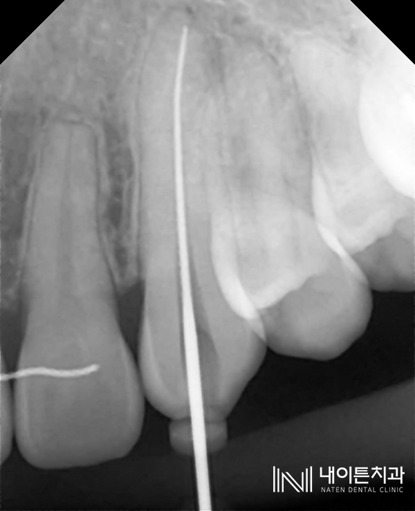 Treatment case image 5