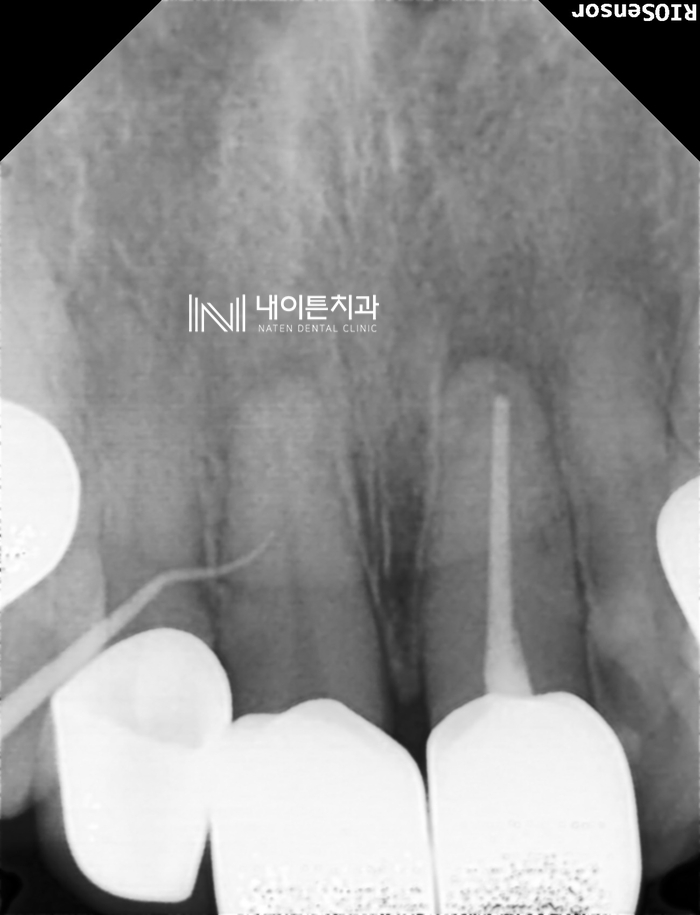 Treatment case image 2