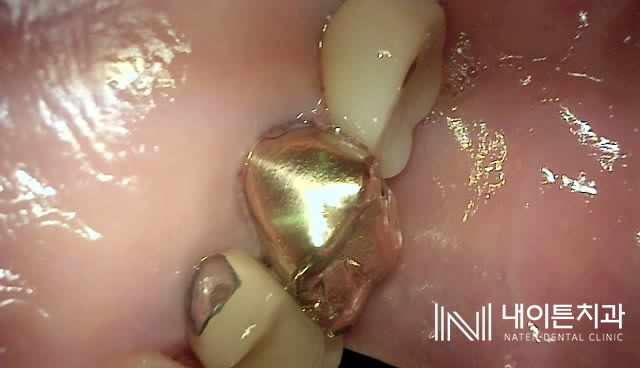 Treatment case image 2