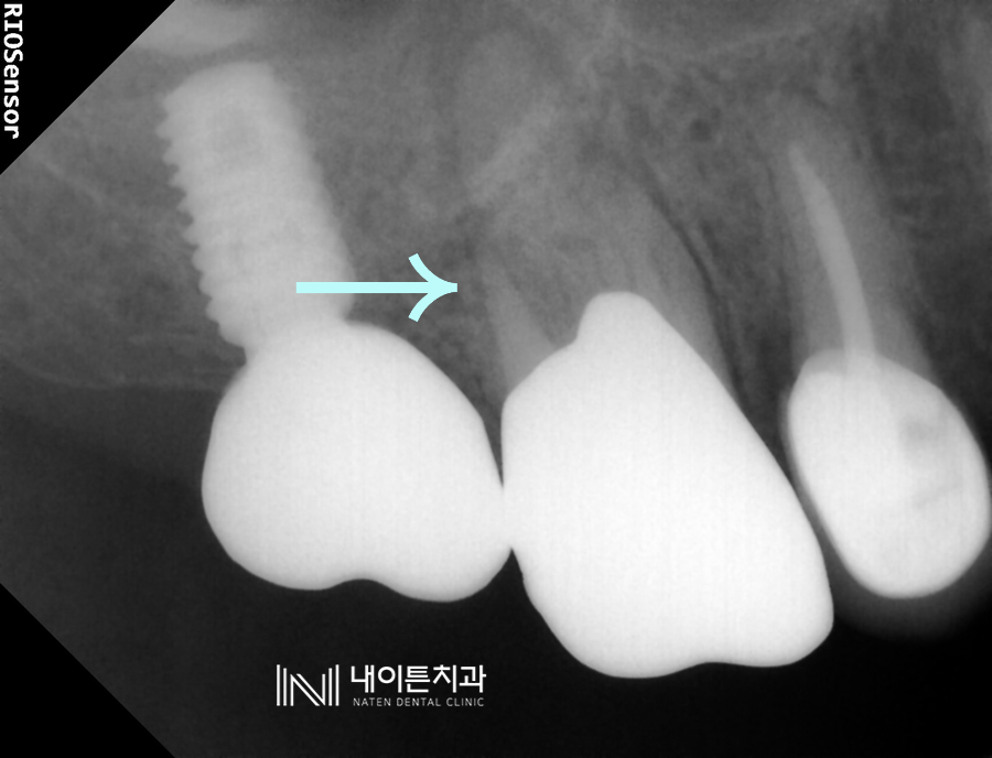 Treatment case image 3