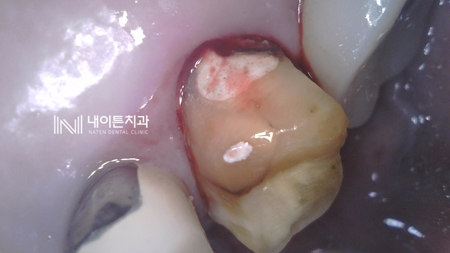 Treatment case image 4