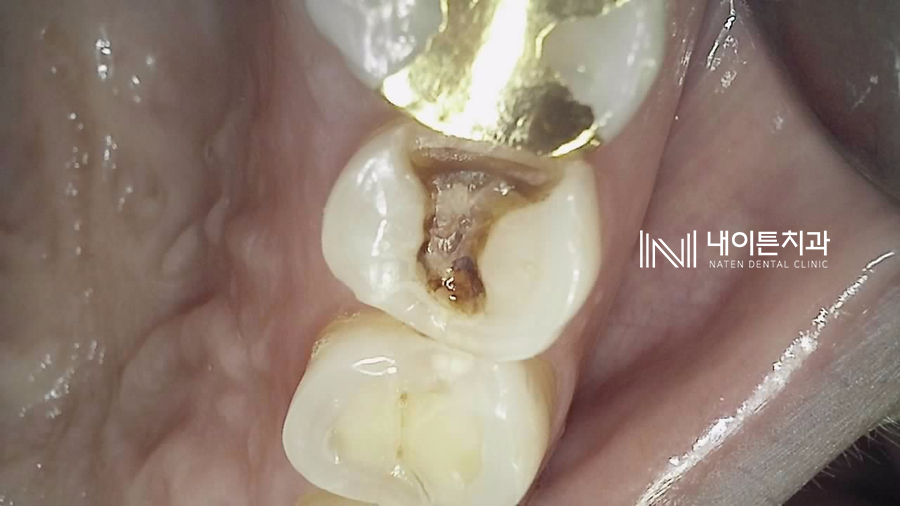 Treatment case image 1