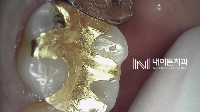 Treatment case image 2