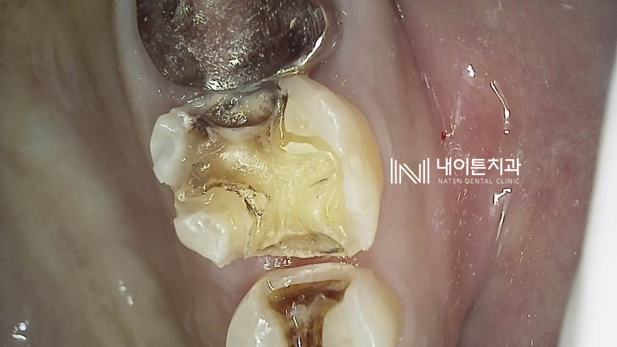 Treatment case image 3
