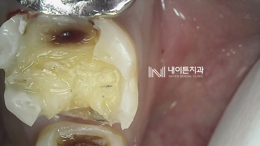 Treatment case image 4