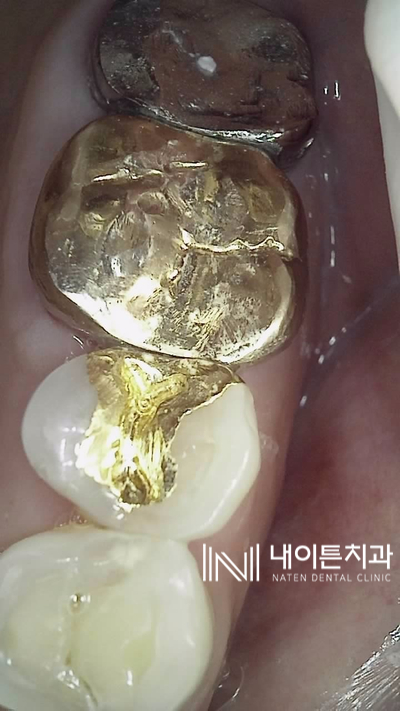 Treatment case image 6