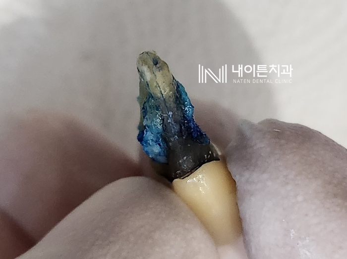 Treatment case image 3