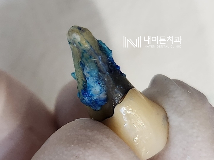 Treatment case image 4