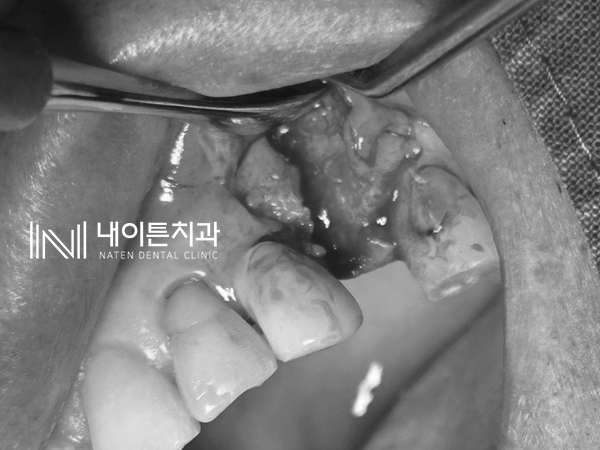 Treatment case image 5