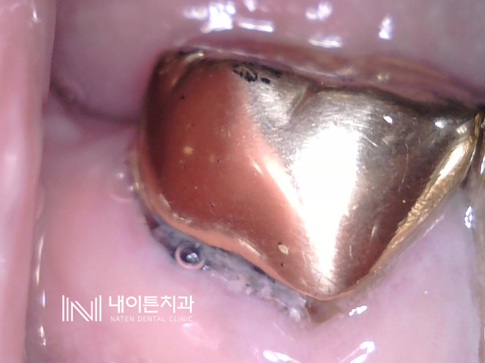 Treatment case image 1