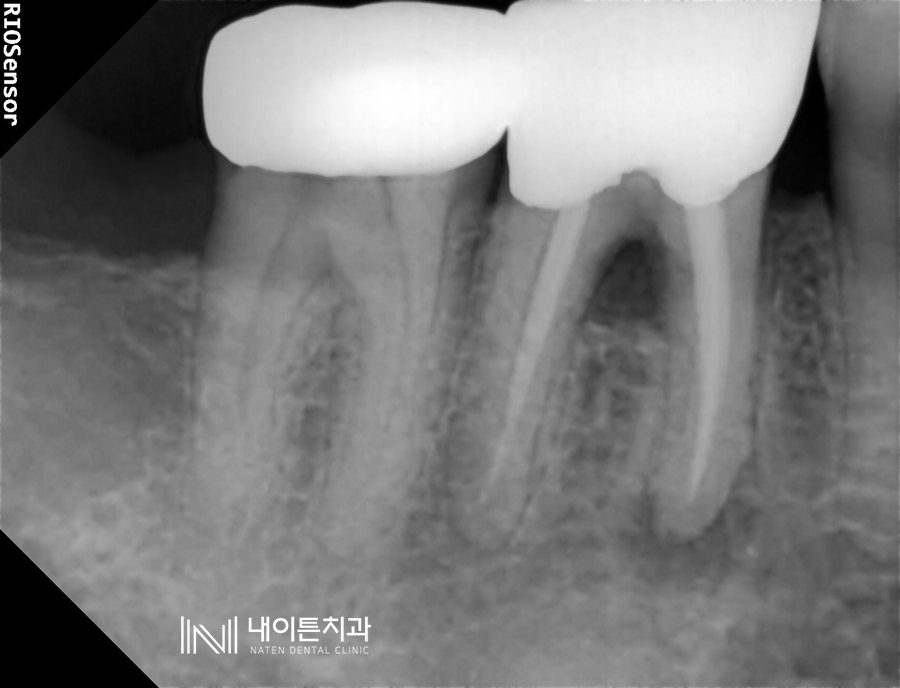 Treatment case image 2