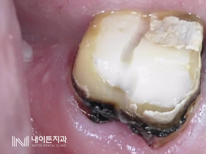 Treatment case image 5