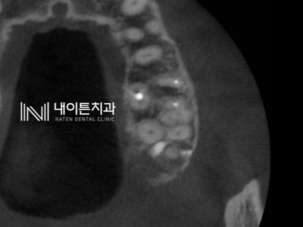 Treatment case image 2