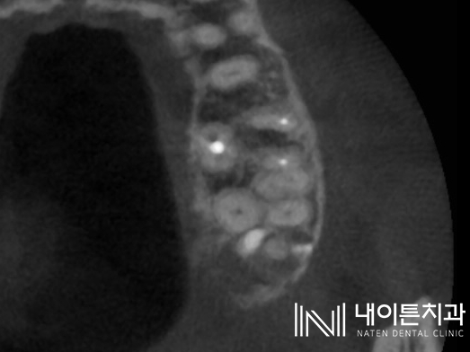 Treatment case image 11