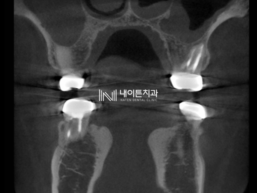 Treatment case image 13