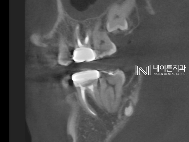 Treatment case image 14