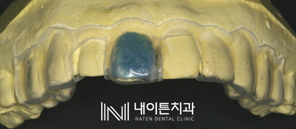 Treatment case image 4