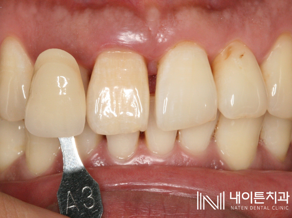Treatment case image 6