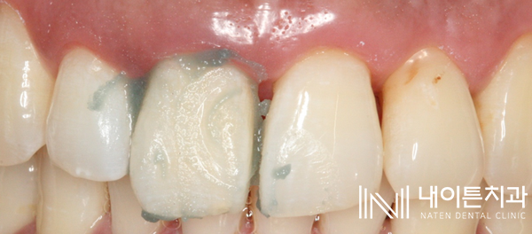 Treatment case image 7