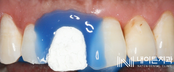 Treatment case image 8