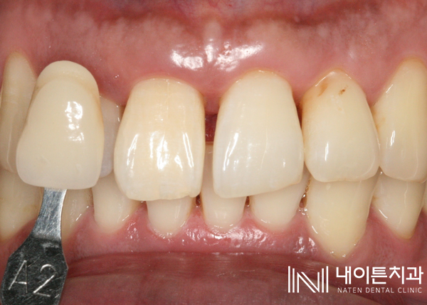 Treatment case image 14