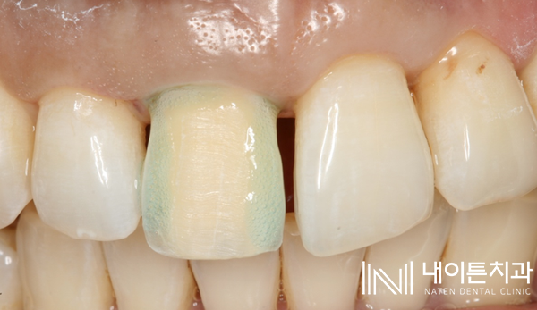 Treatment case image 15