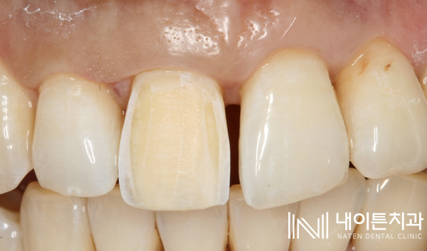 Treatment case image 16