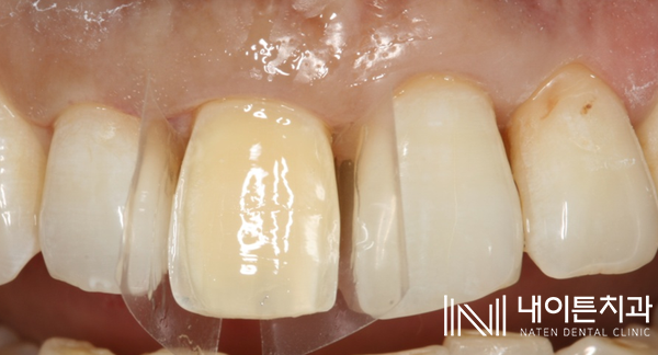 Treatment case image 17