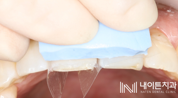 Treatment case image 18