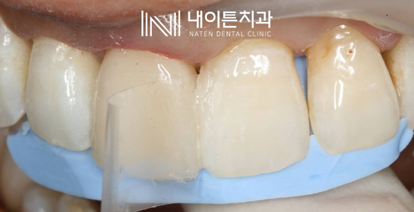 Treatment case image 20