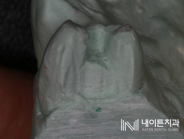 Treatment case image 3