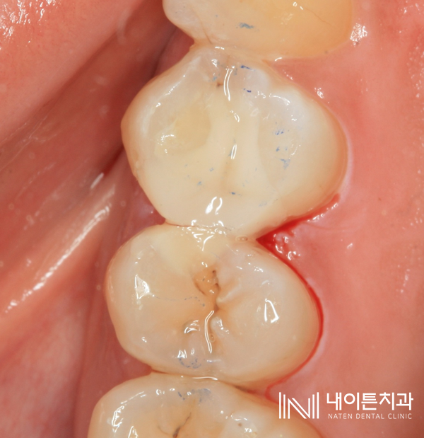 Treatment case image 4