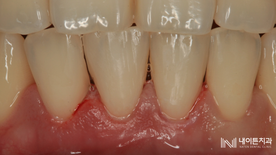 Treatment case image 6