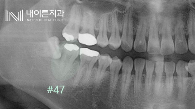 Treatment case image 1