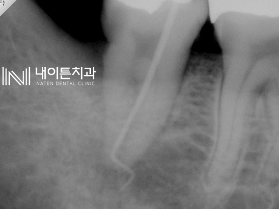 Treatment case image 3