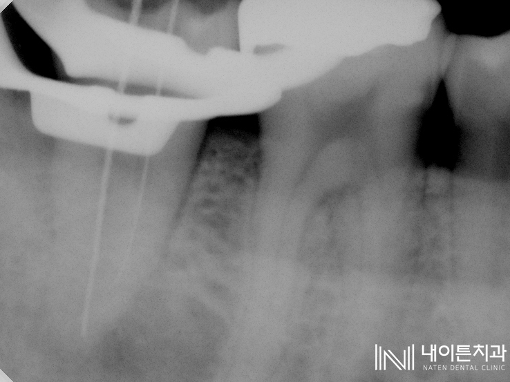 Treatment case image 4