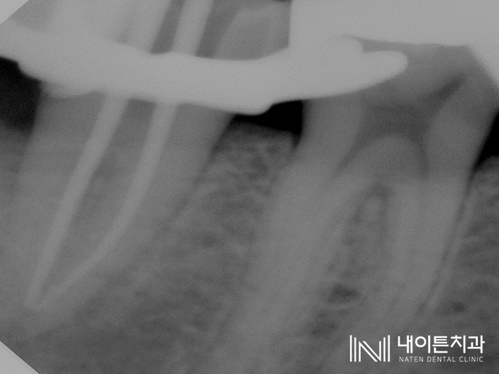 Treatment case image 5