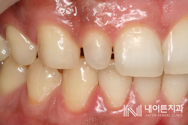 Treatment case image 2