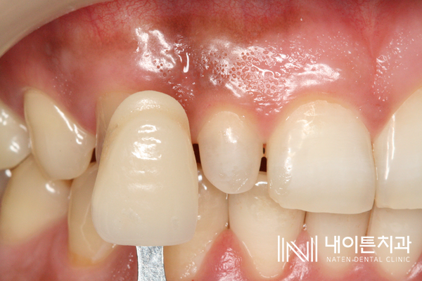 Treatment case image 9
